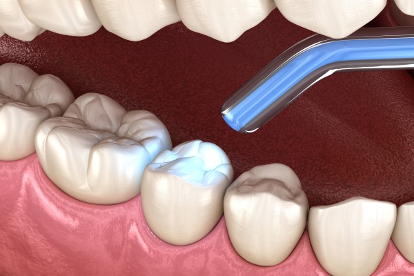 Fillings