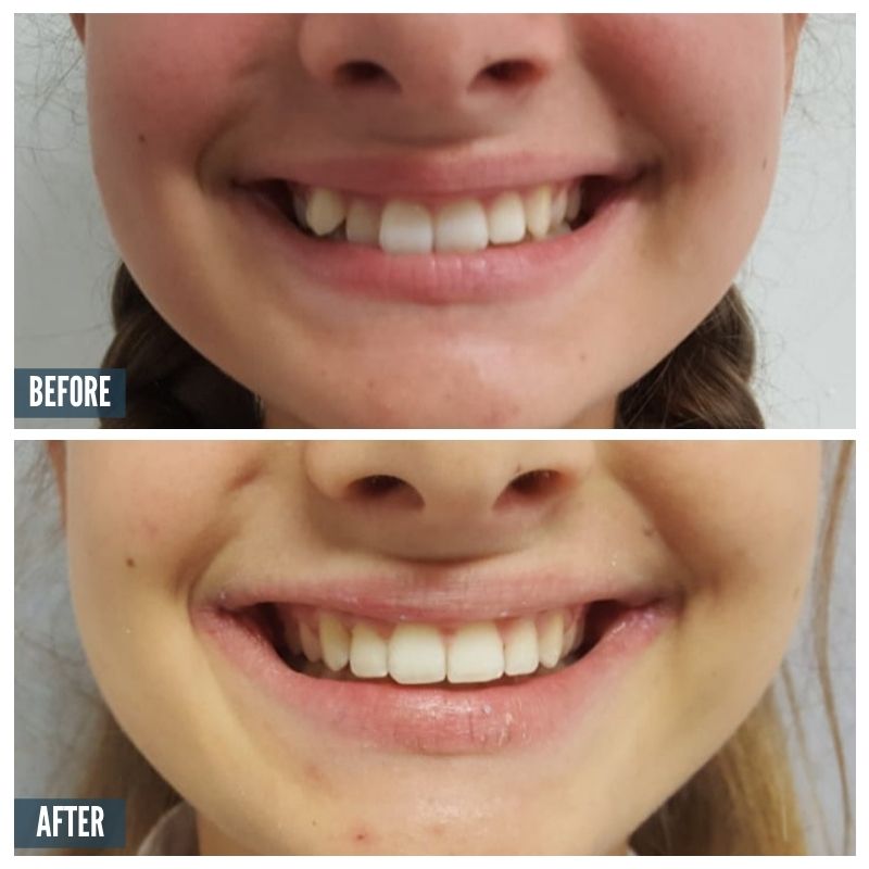 BA 2 Braces 1