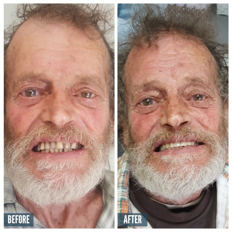 BA 2 Dentures 2